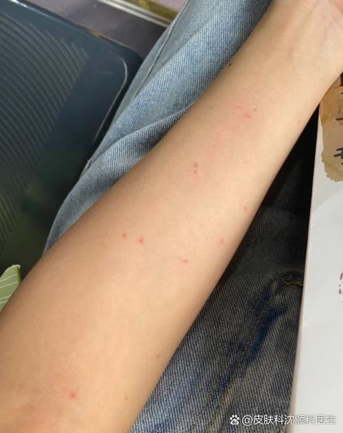胳膊上有小红点像血点
