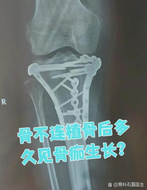 植骨不融合会有哪些表现