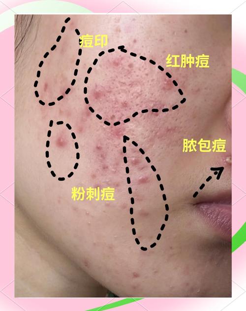 脸上痘印怎么办才能彻底去除