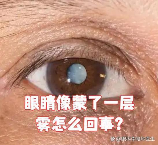眼睛有雾状模糊怎么办