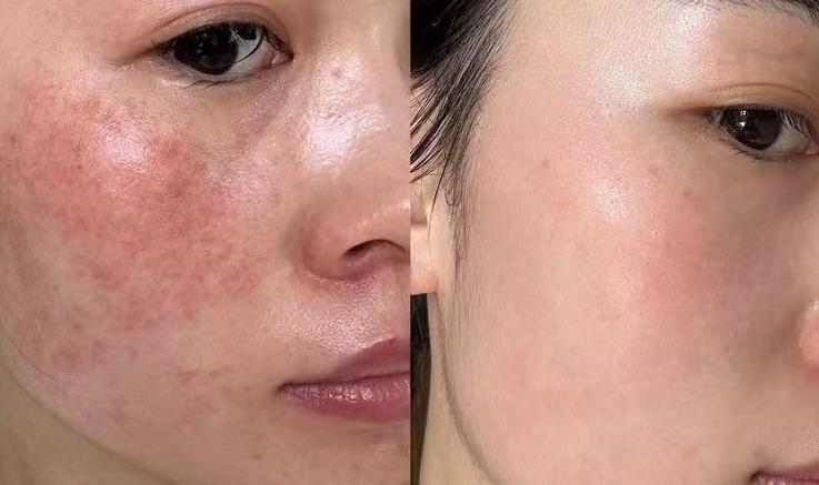 脸部皮肤修复