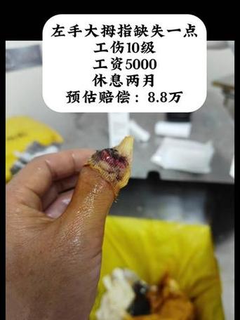 手指工伤赔偿