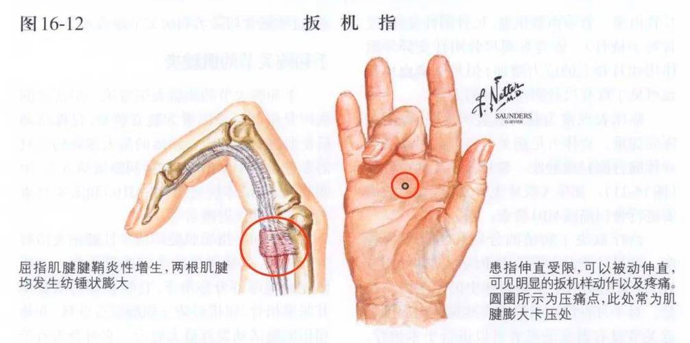 扳机手指怎么治疗