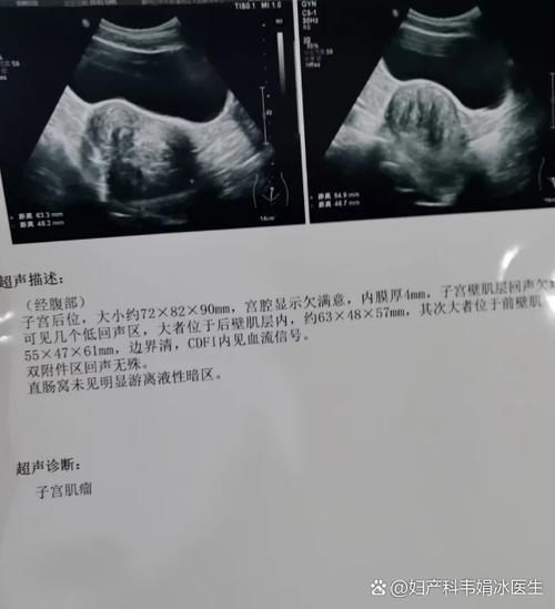 6周阴超只能看到暗区