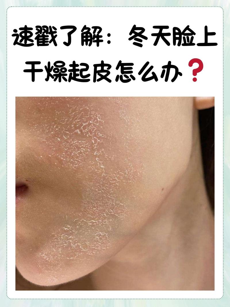 脸上长癣怎么办