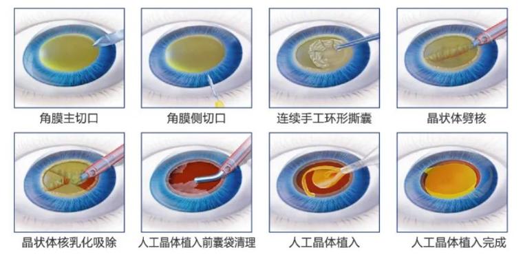 为什么不建议做白内障手术