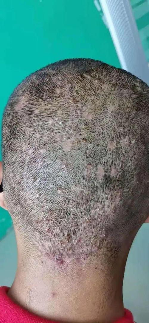 毛囊炎的10种图片