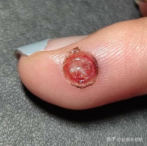 病毒油可以治疗嘛