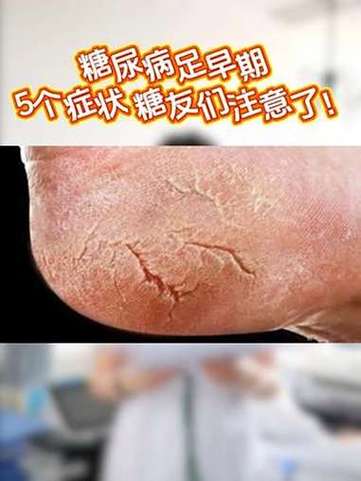 糖尿病足的前兆
