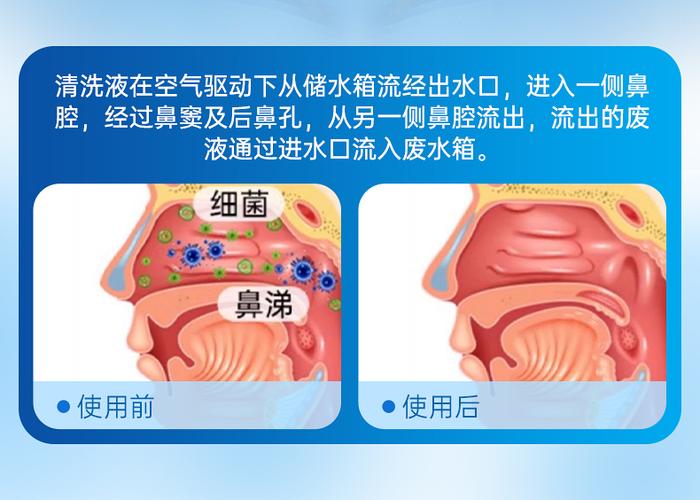 鼻腔清洗器使用方法视频