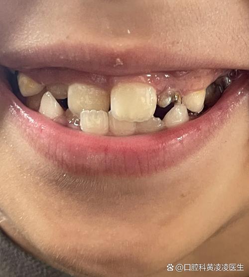 新牙齿长歪了,老牙也不掉截图2