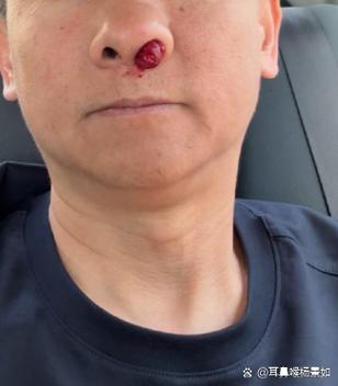 老人流鼻血是什么前兆