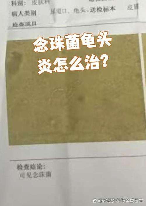念珠菌好了同房一次又复发了