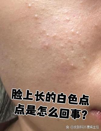 脸上长白点