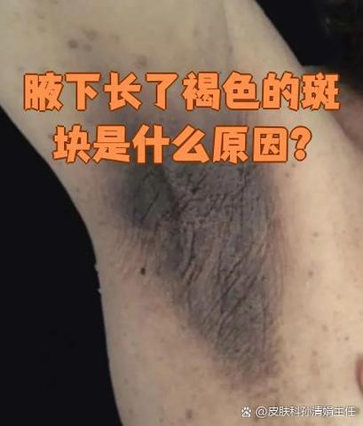 女性腋窝发黑还痒是怎么回事