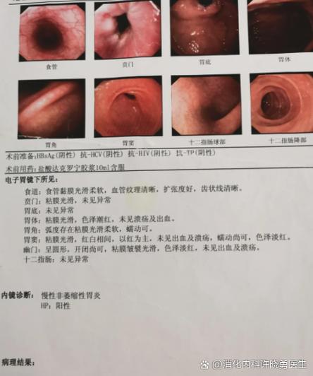 食物堵在胸口消化不了