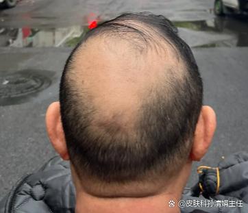 男人秃顶是性功能好还是差