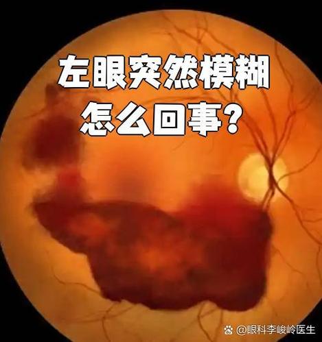 眼睛看不清楚东西模糊