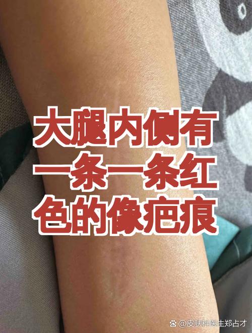 大腿内侧有一条一条红色的像疤痕