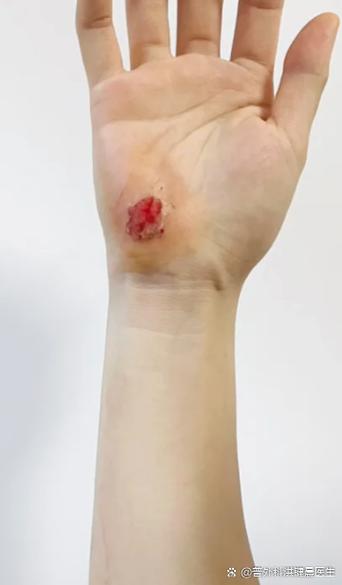 手破了在家怎么消毒
