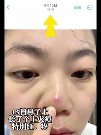 鼻头痘痘挤完红肿怎样快速消退