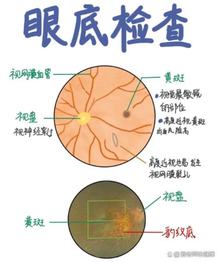为什么医生不建议做眼底检查