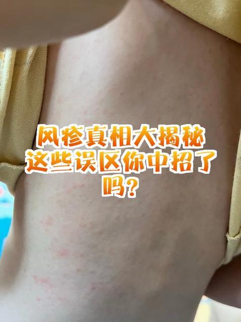 成人猪头风是什么症状
