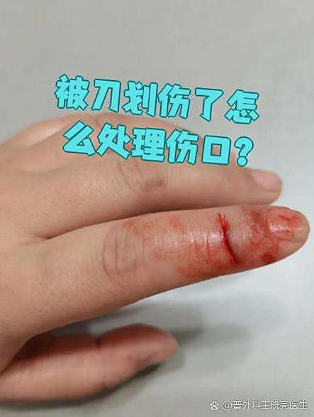 被水果刀划了小口子怎么处理
