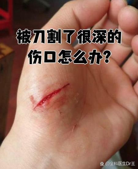 被水果刀划了小口子怎么处理截图2