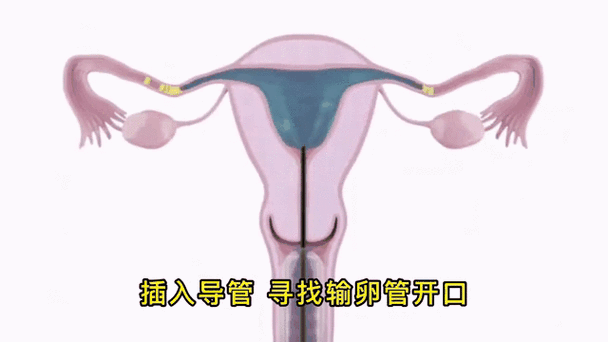 输卵管通液后要注意什么