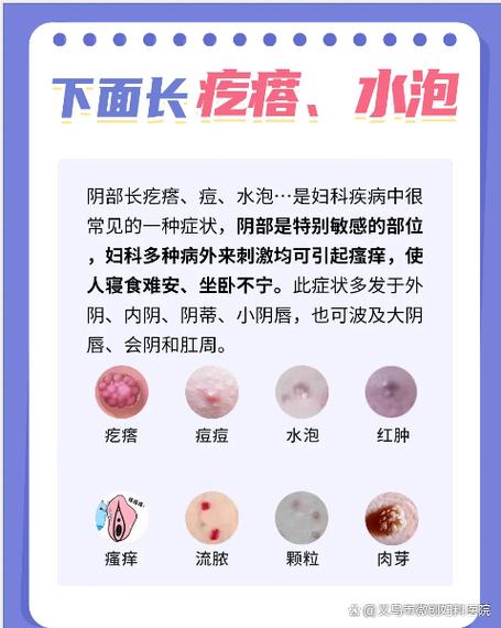 女私密部位长痘痘怎么办