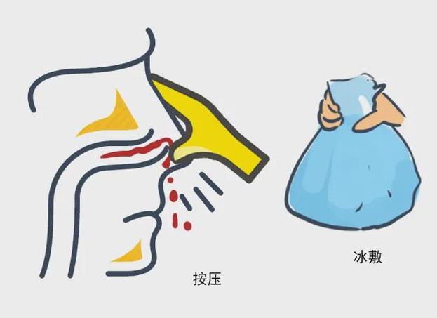 如何制止流鼻血