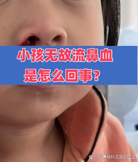 小朋友坐飞机流鼻血