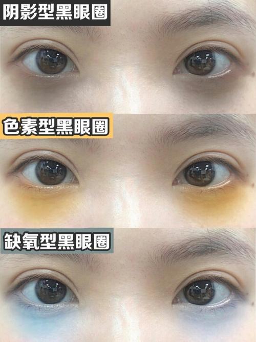 黑眼圈怎么弄掉