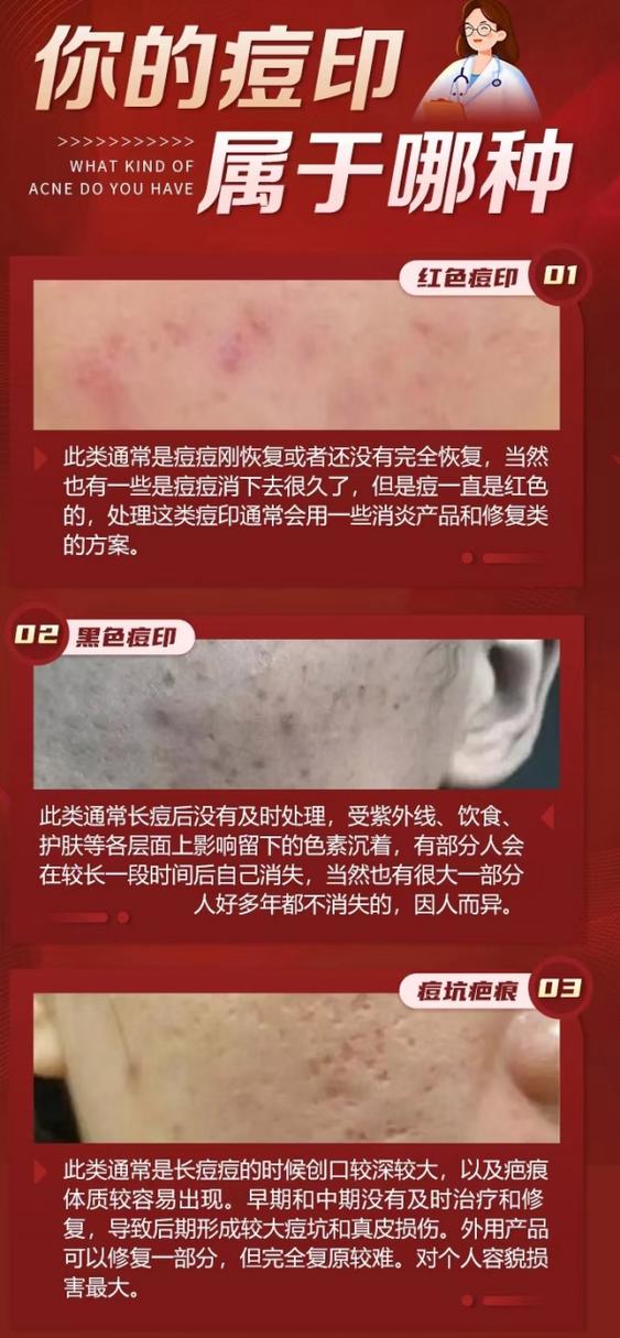 红色痘印自己会淡化吗