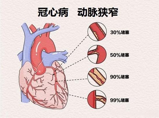 心脏狭窄70～80能保守治疗吗