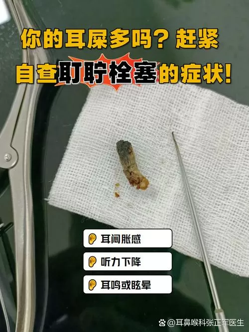 双耳耵聍栓塞什么意思